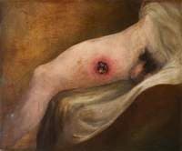 The Wounded following the Battle of Corunna: Gunshot Wound of Thigh