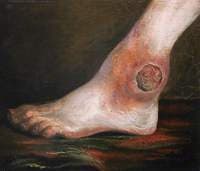 The Wounded following the Battle of Corunna: Gunshot Wound of Ankle Joint