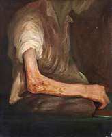 The Wounded following the Battle of Corunna: Musket Ball Wound of Elbow