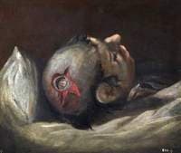 The Wounded following the Battle of Corunna: Musket Ball Wound of Skull