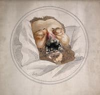 Eroded and Gangrenous Nasal Passage due to Syphillis
