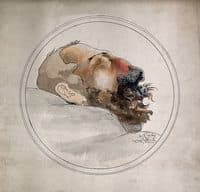 Syphilis:  Face of a Dead Man with Erosion of the Nose